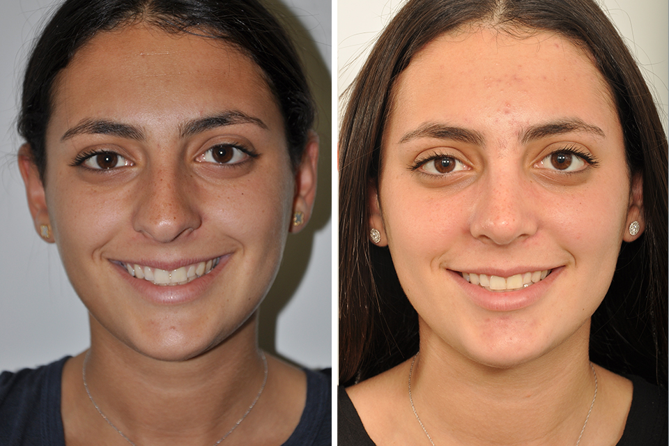 Rhinoplasty case #4192