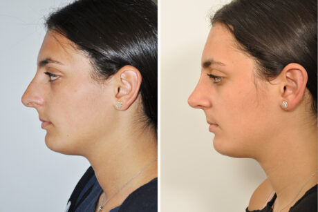 Rhinoplasty case #4192