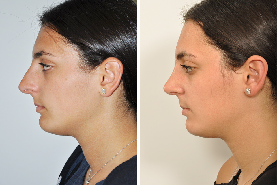 Rhinoplasty case #4192