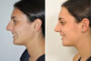 Rhinoplasty case #4192 slider thumbnail