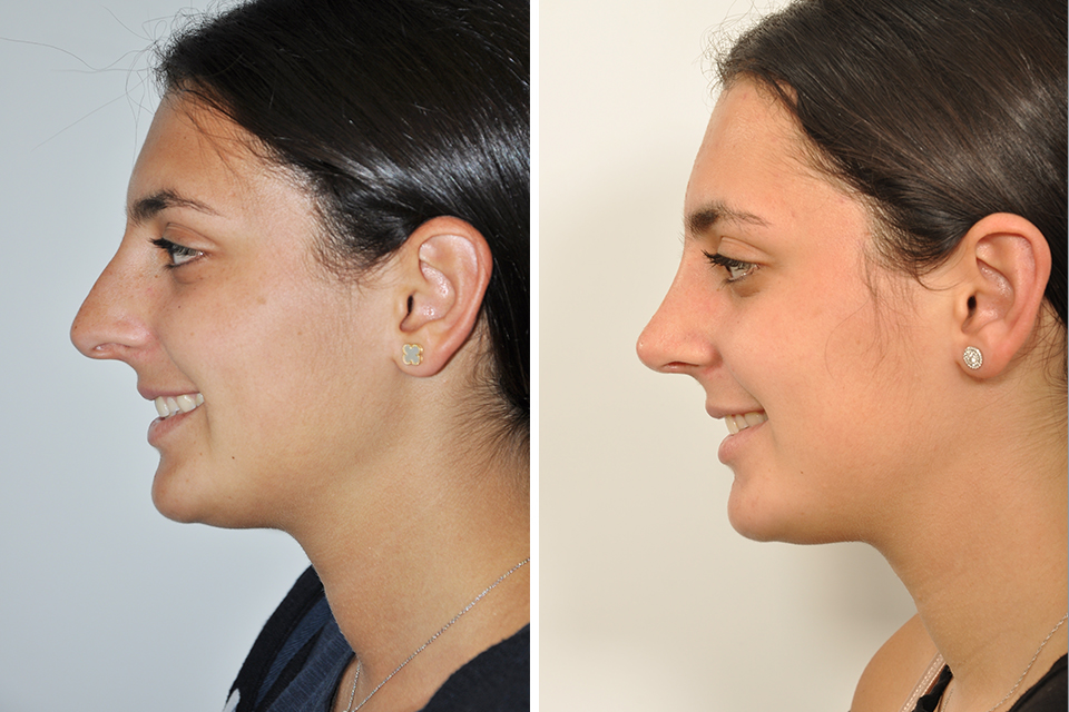 Rhinoplasty case #4192