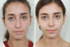 Rhinoplasty case #4164 slider thumbnail