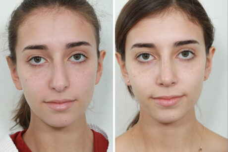 Rhinoplasty case #4164
