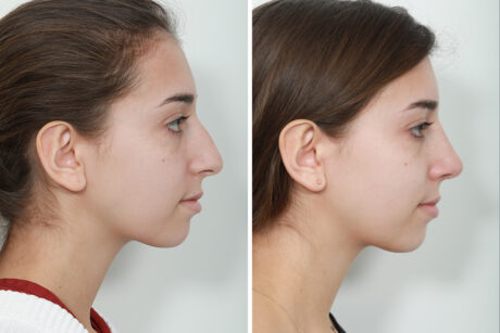 Rhinoplasty case #4164