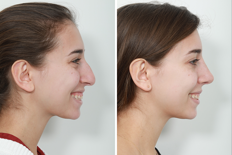 Rhinoplasty case #4164
