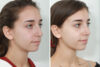 Rhinoplasty case #4164 slider thumbnail