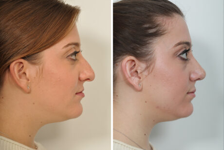 Rhinoplasty case #4203