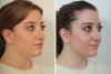 Rhinoplasty case #4203 slider thumbnail