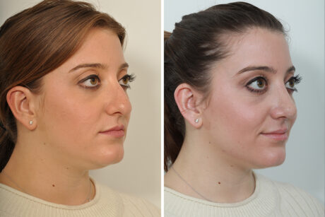 Rhinoplasty case #4203
