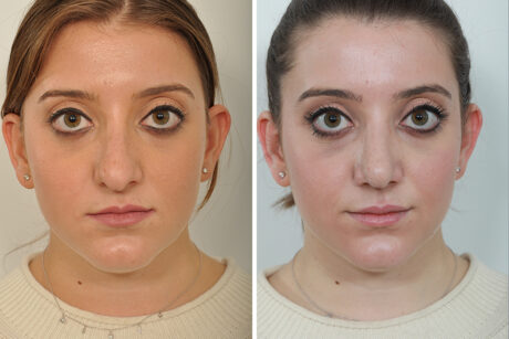 Rhinoplasty case #4203
