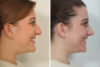 Rhinoplasty case #4203 slider thumbnail