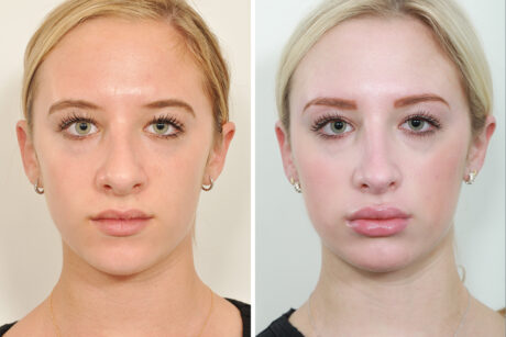 Rhinoplasty case #4208