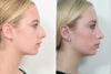 Rhinoplasty case #4208 slider thumbnail