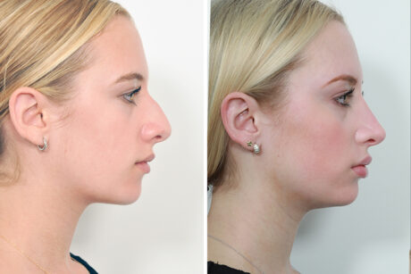 Rhinoplasty case #4208