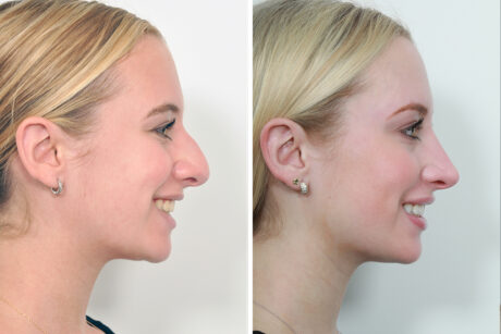 Rhinoplasty case #4208