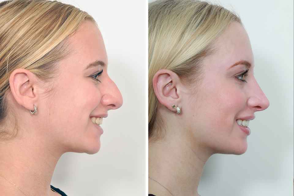 Rhinoplasty case #4208