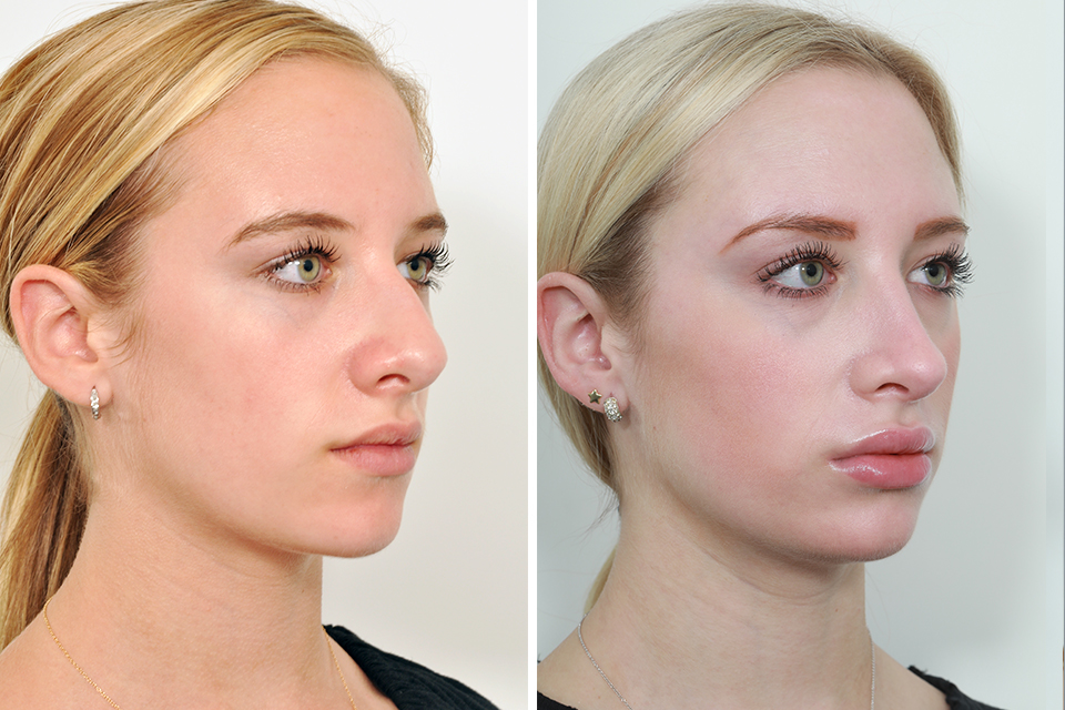 Rhinoplasty case #4208