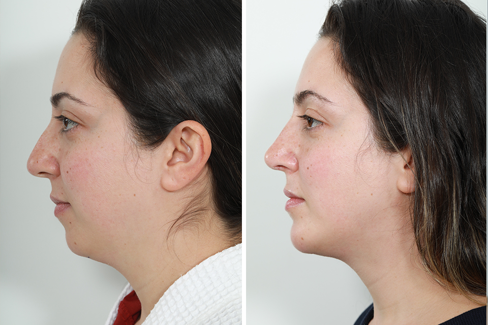 Rhinoplasty case #4197