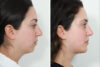 Rhinoplasty case #4197 slider thumbnail