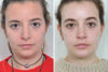 Rhinoplasty case #4200 slider thumbnail