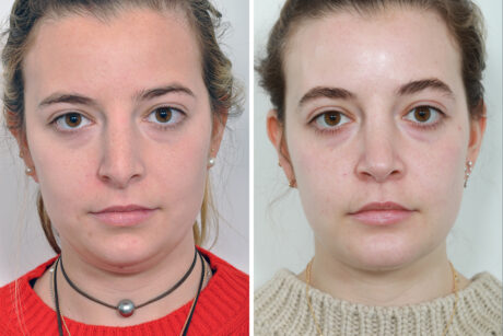 Rhinoplasty case #4200