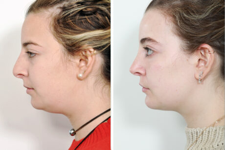 Rhinoplasty case #4200