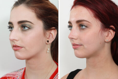 Rhinoplasty case #4046