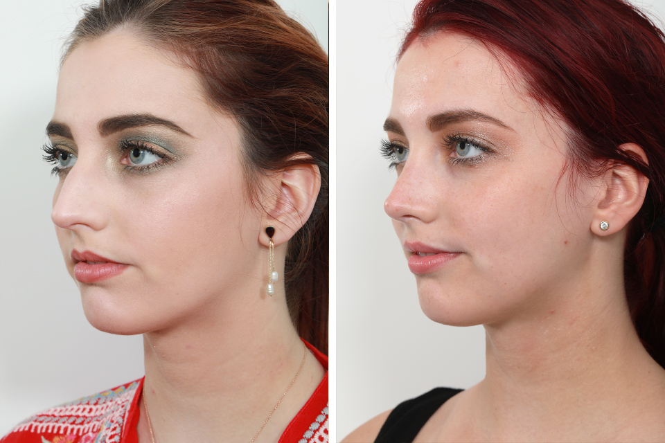 Rhinoplasty case #4046