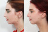 Rhinoplasty case #4046 slider thumbnail