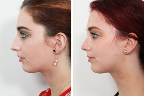 Rhinoplasty case #4046