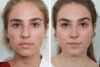 Rhinoplasty case #4183 slider thumbnail