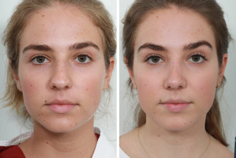 Rhinoplasty case #4183