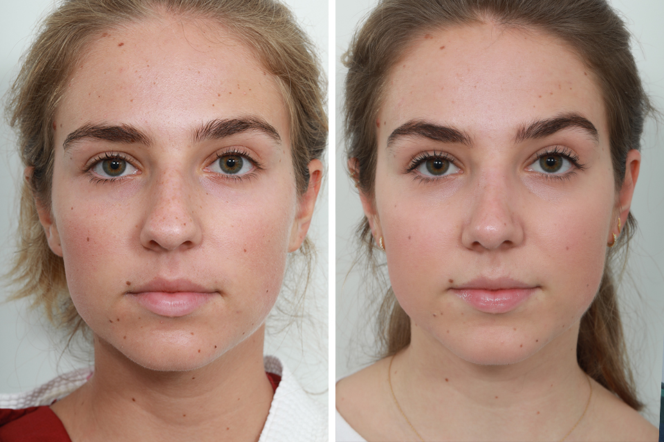 Rhinoplasty case #4183