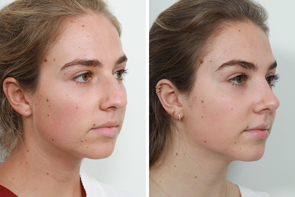 Rhinoplasty case #4183
