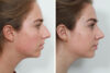 Rhinoplasty case #4183 slider thumbnail