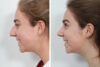 Rhinoplasty case #4183 slider thumbnail