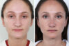 Rhinoplasty case #4178 slider thumbnail