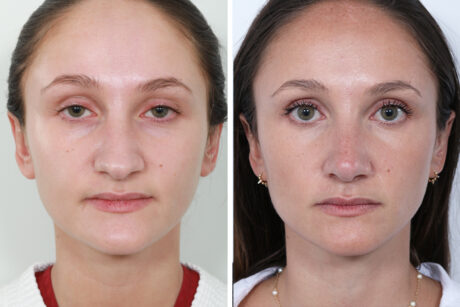 Rhinoplasty case #4178