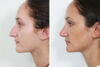 Rhinoplasty case #4178 slider thumbnail