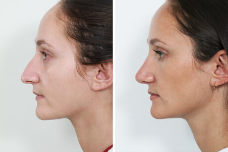 Rhinoplasty case #4178