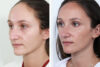 Rhinoplasty case #4178 slider thumbnail
