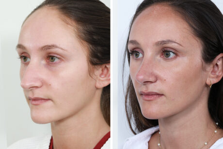 Rhinoplasty case #4178