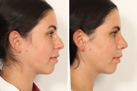Rhinoplasty case #4132