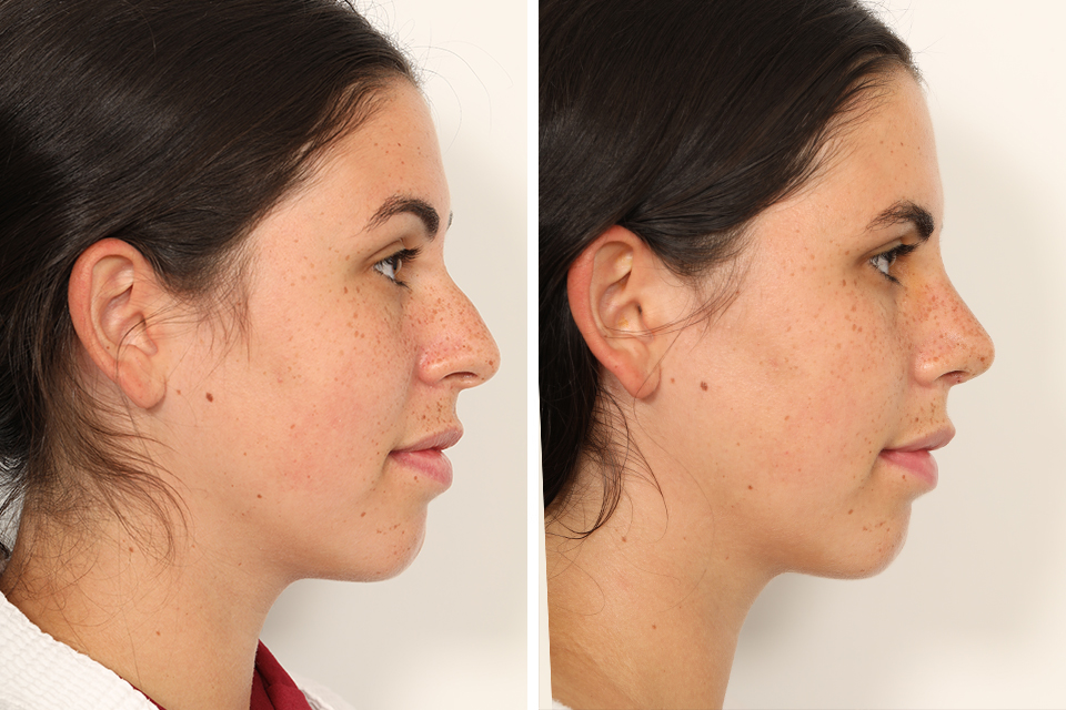Rhinoplasty case #4132