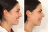 Rhinoplasty case #4132 slider thumbnail
