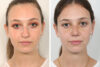 Rhinoplasty case #4155 slider thumbnail