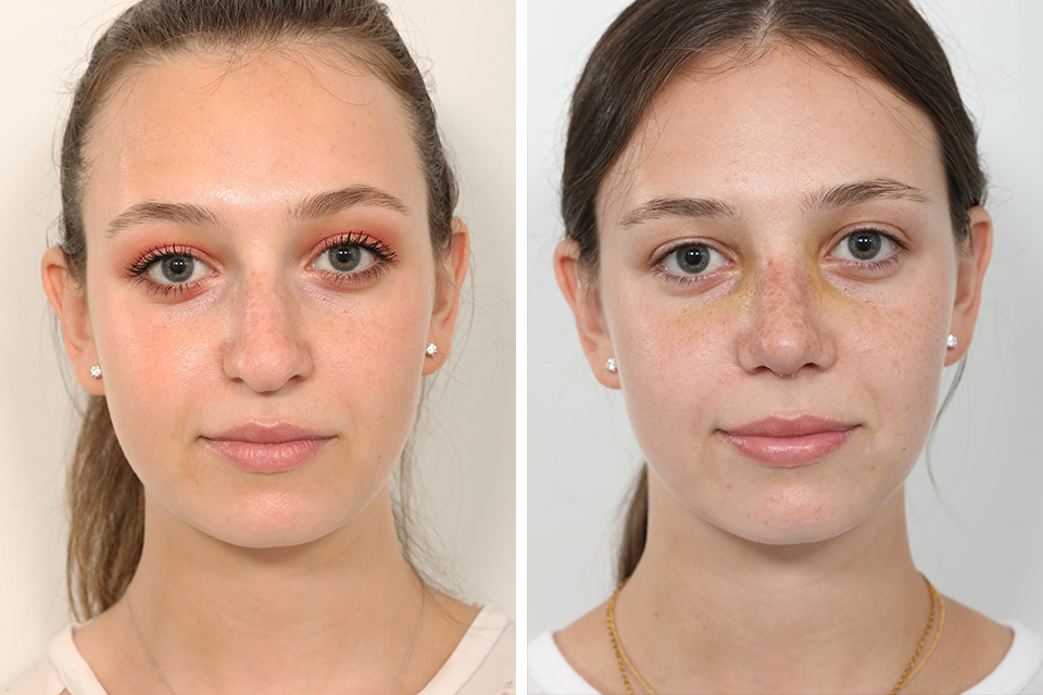 Rhinoplasty case #4155