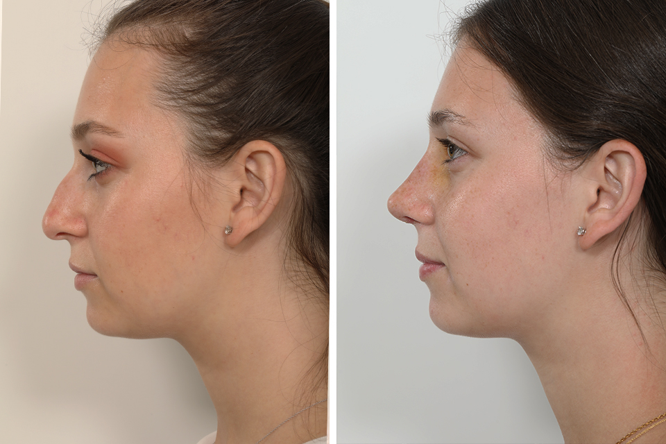 Rhinoplasty case #4155
