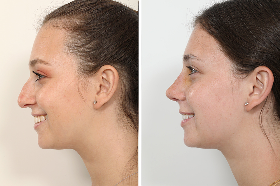 Rhinoplasty case #4155