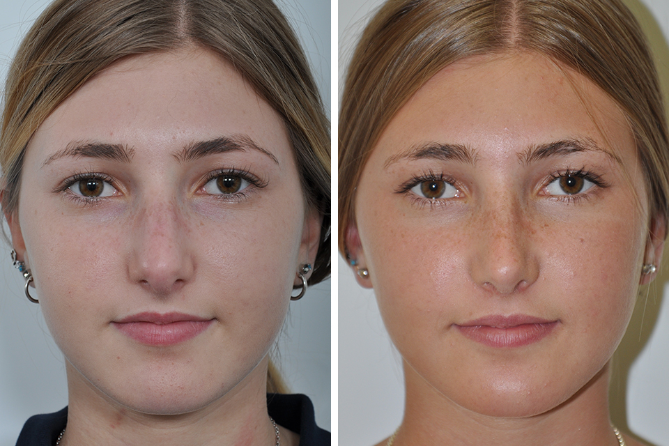 Rhinoplasty case #4098